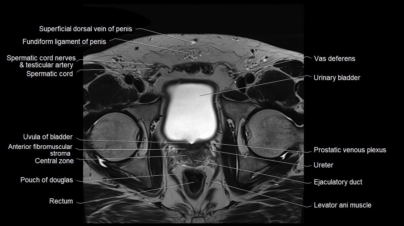 MRI 3T scrotum and penis axial cross sectional anatomy image 5.webp